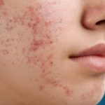 آکنه در بزرگسالی خطر ابتلا به اختلالات خوردن را افزایش می‌دهد
