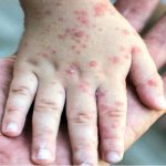روند افزایشی شیوع سرخک در آمریکا
