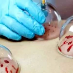 حجامت در بهار فواید و بهترین زمان برای انجام آن