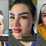 کاشت ابرو اقساطی در تهران با شرایط پرداخت آسان