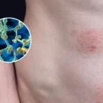 قارچ تناسلی TMVII چیست و چگونه از طریق رابطه جنسی منتقل می‌شود؟