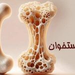 پوکی استخوان در کودکان، واقعیتی فراموش‌شده