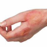 ترمیم جای زخم قدیمی با سلول بنیادی چگونه انجام می‌شود؟ + مزایا و کارکرد