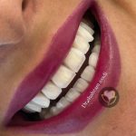 مزایای ایمپلنت دندان و معرفی کاشت ایمپلنت به روش پانچ: تجربه‌ای سریع، راحت و مطمئن