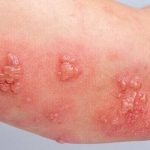 ویژگی‌های خاص واکسن زونا