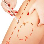 جراحی لیفت ران چیست و به چه روش هایی انجام می شود؟